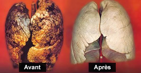 Poumons avant et après